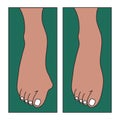 Hallux valgus, foot deformation Royalty Free Stock Photo