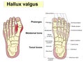 Hallux valgus text. Anatomy. Human foot bones. Signatures, also for clinics Royalty Free Stock Photo
