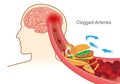 Hamburger and Pizza and French fries block red blood cell cause clogged in artery before into brain.