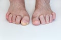 Hammer toe feet