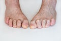 Hammer toe feet Royalty Free Stock Photo