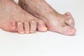 Hammer toe feet