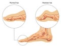 Hammer toe Royalty Free Stock Photo