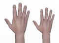 Hand with acromegaly and the same healthy hand, 3D illustration Royalty Free Stock Photo