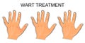 Hand affected by the wart