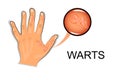 Hand affected by the wart