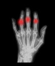 Hand with arthrosis Royalty Free Stock Photo