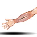 Hand Bone Fracture - Distal radius fracture and broken arm bone types anatomy - Vector Illustration on white background