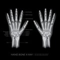Hand Bone X-Ray