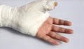 hand with chalk put by the hospital after the serious injury