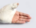 Hand with chalk to immobilize the thumb with a broken bone