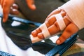 Hand of a child with splinted fingers