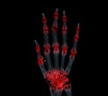 Hand 3D rendering for rheumatoid arthritis Concept