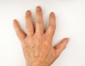 Hand Deformed From Rheumatoid Arthritis Royalty Free Stock Photo