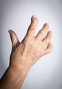 Hand Deformed From Rheumatoid Arthritis