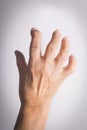 Hand Deformed From Rheumatoid Arthritis