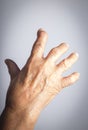 Hand Deformed From Rheumatoid Arthritis Royalty Free Stock Photo