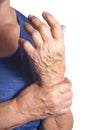 Hand Deformed From Rheumatoid Arthritis