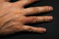 Hand dermatitis. Hand eczema