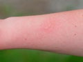 Hand with dermatitis red itchy swollen skin after touching nettle leaves sharp hairs. Plant Urtica dioica allergy Royalty Free Stock Photo