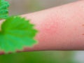 Hand with dermatitis red itchy swollen skin after touching nettle leaves sharp hairs. Plant Urtica dioica allergy Royalty Free Stock Photo