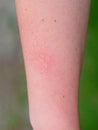 Hand with dermatitis red itchy swollen skin after touching nettle leaves sharp hairs. Plant Urtica dioica allergy Royalty Free Stock Photo