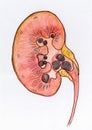 Hand drawn watercolor illustration of kidney stones