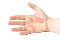 Hand Eczema