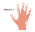 Hand and effect of vitiligo Royalty Free Stock Photo