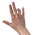 Hand of a female patient with Dupuytren's contracture, photorealistic 3D illustration