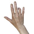 Hand of a female patient with Dupuytren's contracture, photorealistic 3D illustration