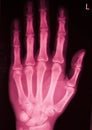 Hand and finger injury xray scan Royalty Free Stock Photo