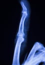 Hand and finger injury xray scan Royalty Free Stock Photo