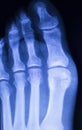 Hand and finger injury xray scan Royalty Free Stock Photo