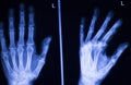 Hand and finger injury xray scan Royalty Free Stock Photo