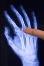 Hand and finger injury xray scan Royalty Free Stock Photo