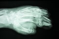 Hand finger thumb hospital xray scan Royalty Free Stock Photo