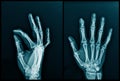 Hand and finger x-ray image Royalty Free Stock Photo