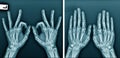 Hand and finger x-ray image Royalty Free Stock Photo