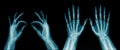Hand and finger x-ray image Royalty Free Stock Photo
