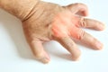 hand and fingers tendinitis ,office syndrome