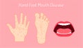 hand foot mouth disease. enteroviruses or EV71 is name of virus. be careful of your chidren and yourself. beautiful color Royalty Free Stock Photo