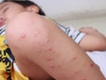 Hand foot and mouth virus causes red blisters on the knees leg plague