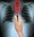 Hand holding Magnifying glass on X-ray of a human thorax with esophagus highlighted in red Royalty Free Stock Photo