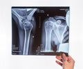 Hand holding shoulder, clavicle X-ray image. Acromion, acromial end fracture. Arm injury. Health care, medical imaging Royalty Free Stock Photo