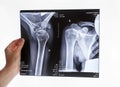 Hand holding shoulder, clavicle X-ray image. Acromion, acromial end fracture. Arm trauma. Health care, injury Royalty Free Stock Photo