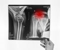 Hand holding shoulder, clavicle X-ray image with red point. Acromion, acromial end fracture. Arm injury. Health care Royalty Free Stock Photo