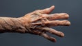 The hand in this image shows signs of stiffness and limited movement both common symptoms of arthritis. The fingers are