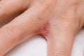 Hand with interdigital dermatitis, dyshidrotic eczema on hand close up Royalty Free Stock Photo