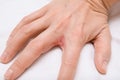 Hand with interdigital dermatitis, dyshidrotic eczema on hand close up Royalty Free Stock Photo